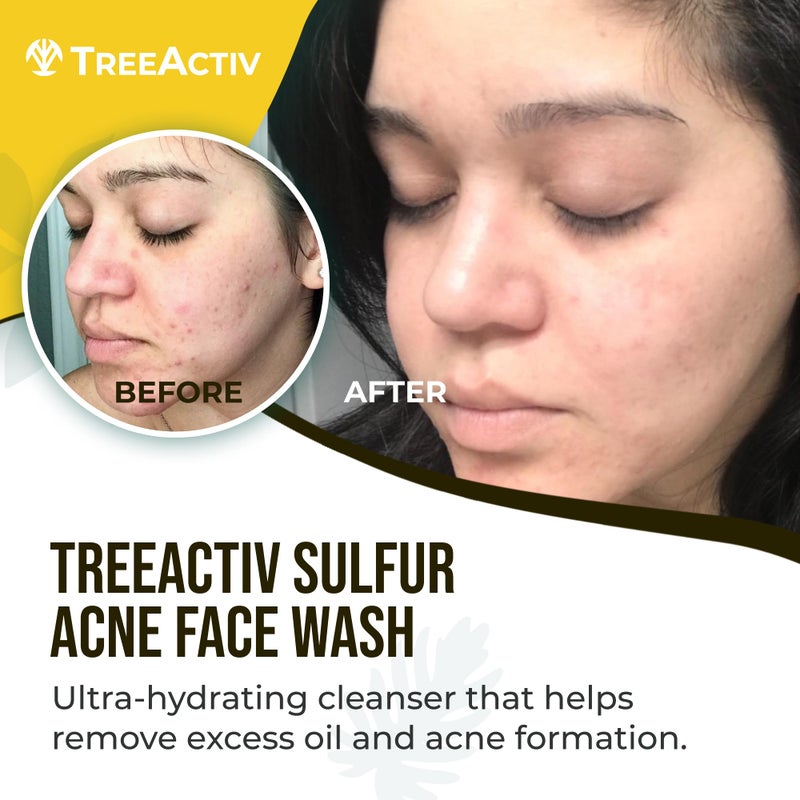 TreeActiv Sulfur Acne Face Wash Original Formula, 8 fl oz, Exfoliating Acne Face Wash for Men & Women, Sulfur Acne Wash for Acne, Activated Charcoal & Pumice, Foaming Daily Women and Men's Face Wash - Image 2