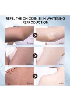 Sumifun Cleansing Keratosis Pilaris Lotion Chicken Skin Removal Skin Moisturizer And Acne Repair Body Refreshing Cream Fast Effective Relief Restoring Body Lotion for Daily and Night Body Use 30G  - Image 4