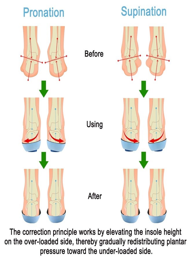 Endoto Supination and Pronation Correction Insoles for Men Women Kids Toddlers, Adjustable Corrective Inserts for Over Supination and Overpronation(Size:4XL) - Image 2