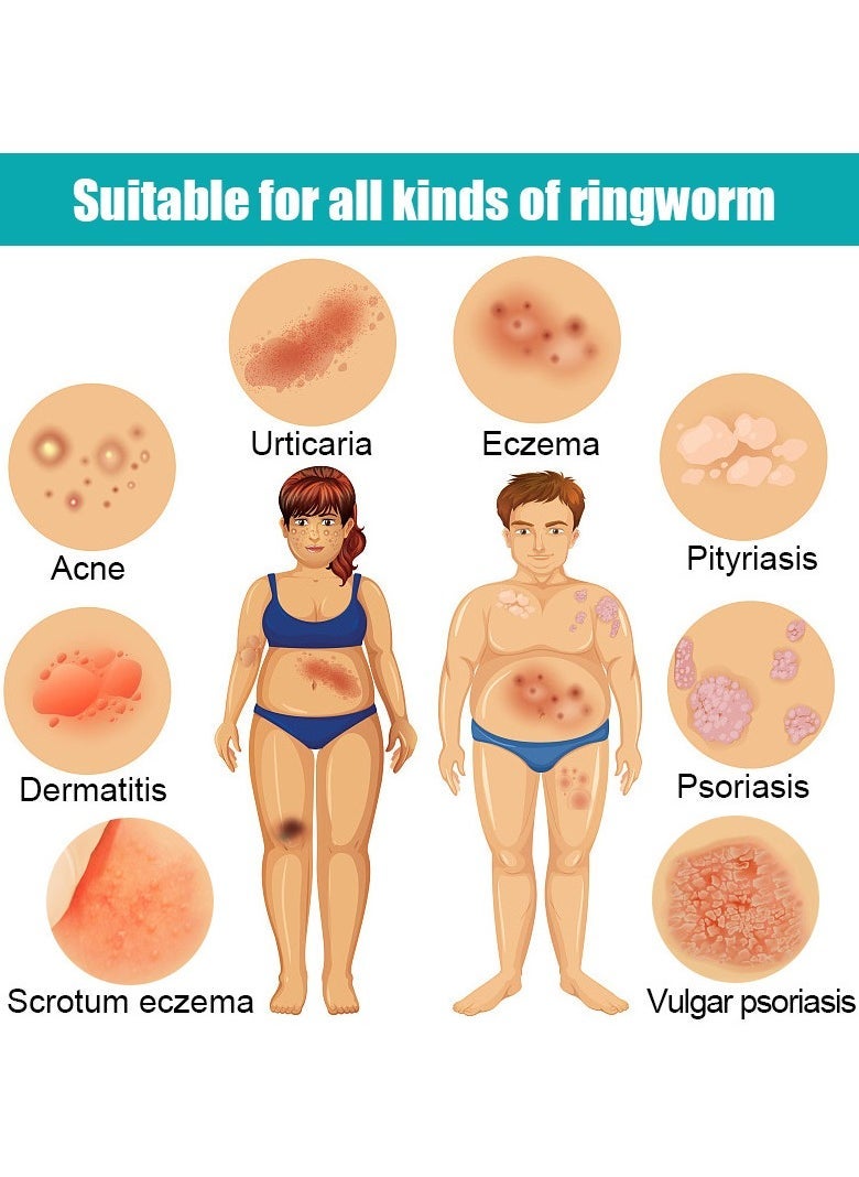 KanyeHB كريم الإكزيما، مرهم قوي لعلاج الطفح الجلدي، الصدفية، التهاب الجلد، الشرى، السعفة، حكة الفخذ، العدوى الفطرية، مضاد للحكة، تخفيف - 20 جرام - Image 2