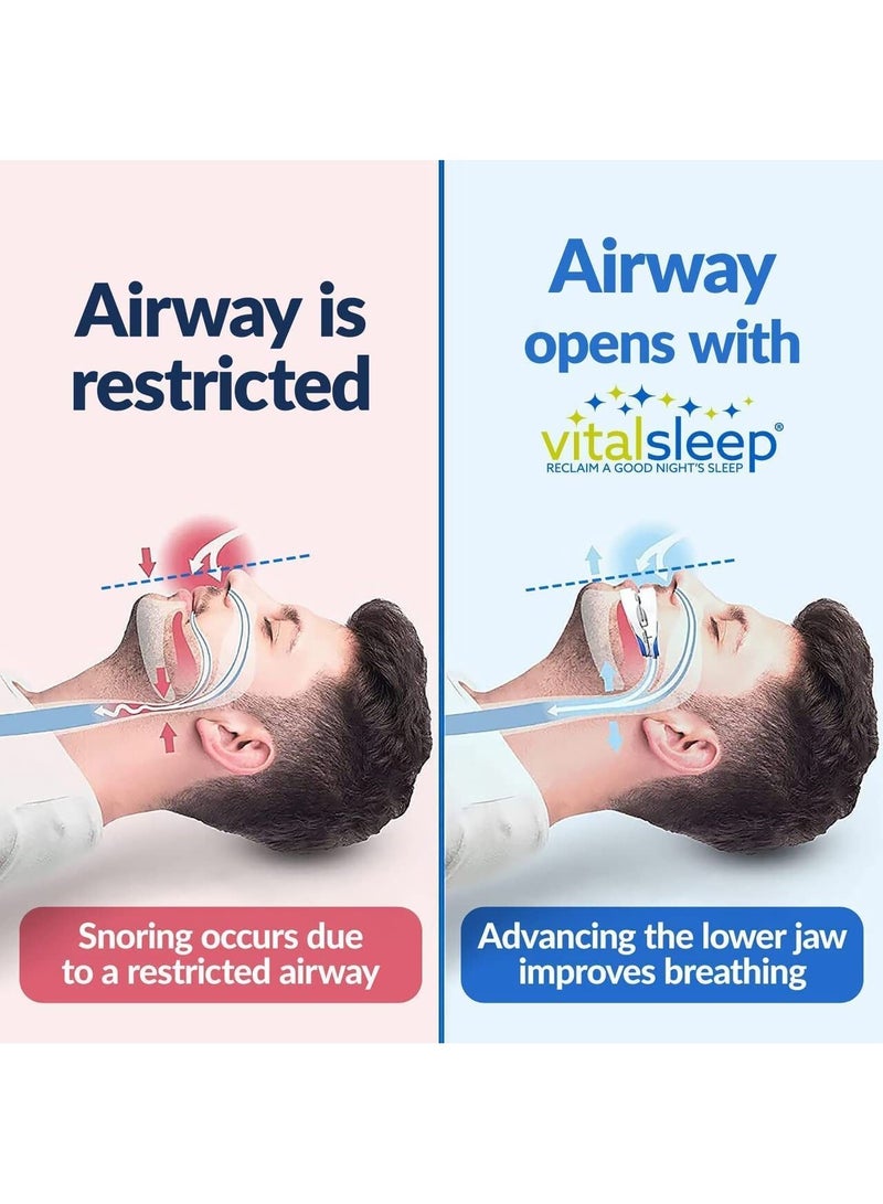 NIBEMINENT Anti-snoring Device Mouthpiece, Upgraded Adjustable Mouth Type Silicone Device, Help Sleep at Night, Prevent Snoring and Snoring, Anti-grinding Braces (Standard Size) - Image 2