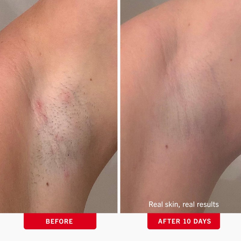 First Aid Beauty - Ingrown Hair Pads with BHA + AHA - Aftershave Treatment Pads to Help Prevent Razor Bumps for Men & Women - Exfoliate Underarms & Bikini Area - Compostable for Daily Use - 60 Pads - Image 3