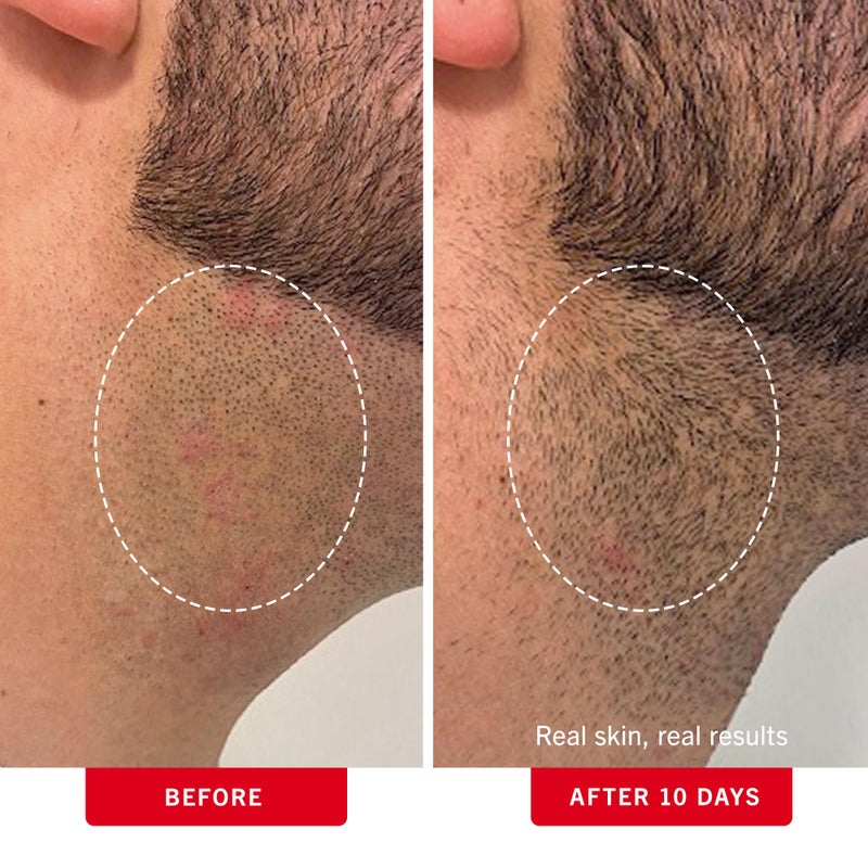 First Aid Beauty - Ingrown Hair Pads with BHA + AHA - Aftershave Treatment Pads to Help Prevent Razor Bumps for Men & Women - Exfoliate Underarms & Bikini Area - Compostable for Daily Use - 60 Pads - Image 4