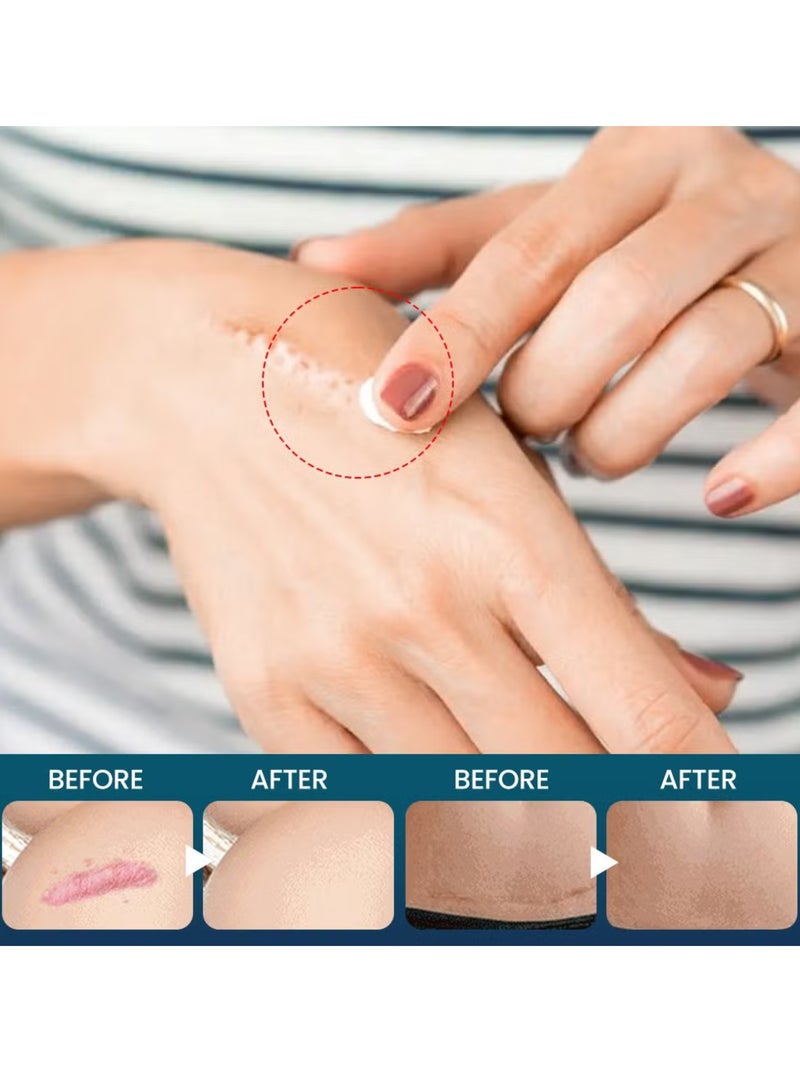 Sumifun Lavender Skin Care Cream Scar Repair Creams for Scald Burns Stretch Marks Acne Scars and Old Scars Soothing Lavender Infusion for Skin Recovery Scar and Stretch Mark Removal Cream 20g - Image 2