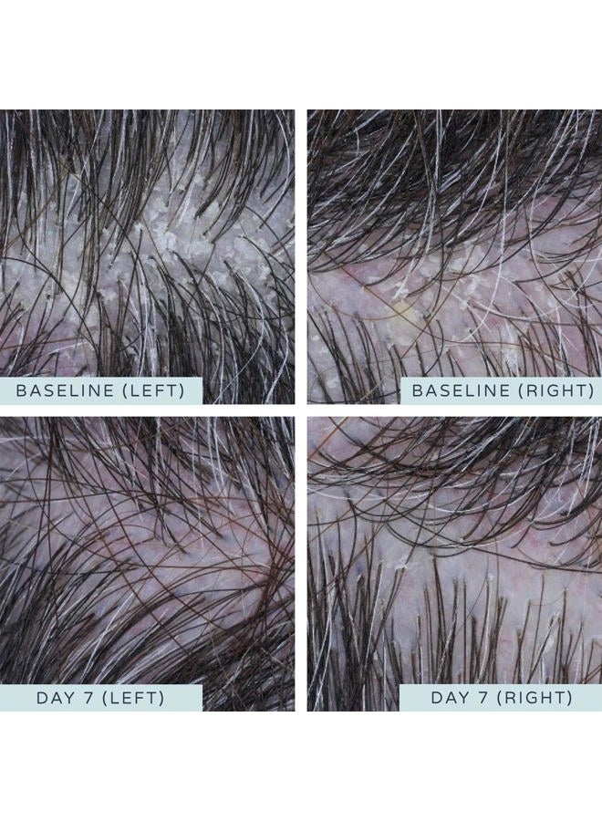 Ameliorate Clarifying Scalp Exfoliant 125ml | Lab6, Lactic Acid, Alpha Hydroxy Acid| Dermatologically tested, Trichologist Approved - Image 3