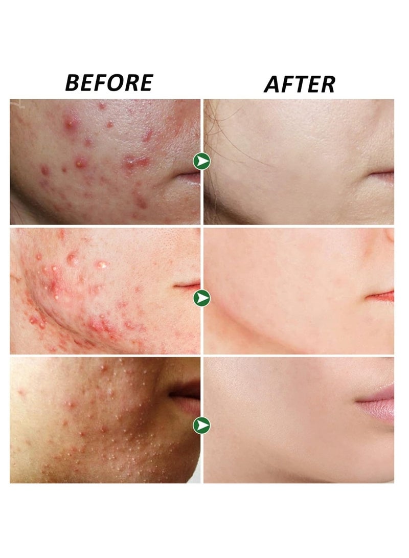 YOUBUY Anti Acne Remove Acne and Treats Blackheads Gel for Day Use Remove Acne Pimple and Treats Blackhead with Azelaic Acid Oil Control Shrink Pores Redness Relief Skin Lightening Scar Fade Cream Acne Remover Cream 20g - Image 3