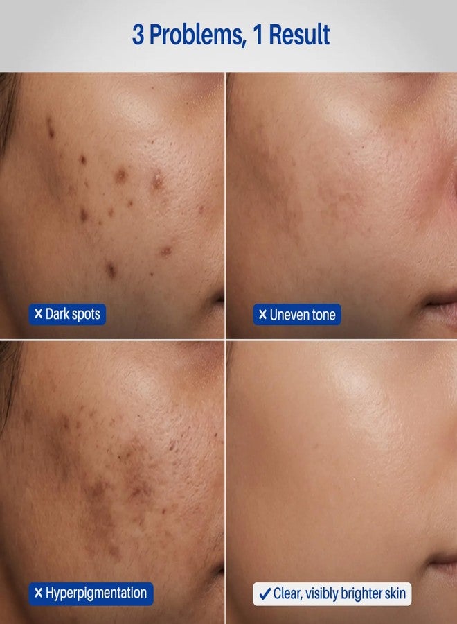 DERMDOC 2% Kojic Acid Face Serum, 20ml | Dark Spots & Pigmentation Control | Brightening, Even-Tone Formula with Niacinamide + Alpha Arbutin + Glutathione | Spot Corrector Serum for Acne Marks, Tanning & Uneven Skin Tone - Image 3