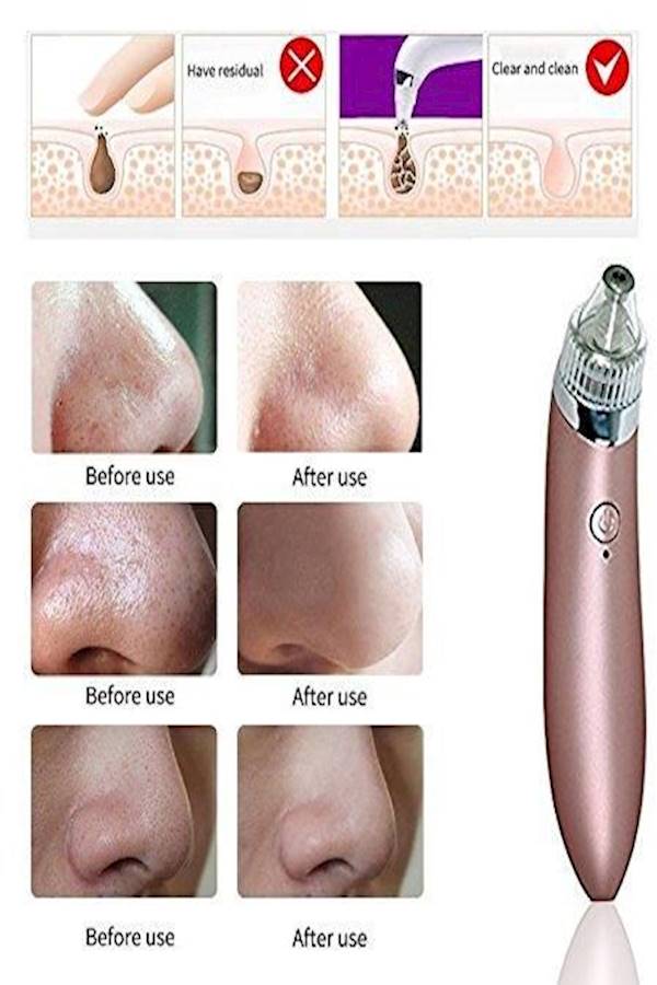 Generic - Blackhead Remover Electronic Facial Pore Cleaner Acne Vacuum - Image 1