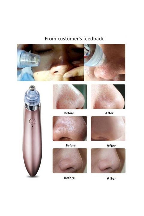 Pore Cleanser And Blackhead Remover Kit Multicolour