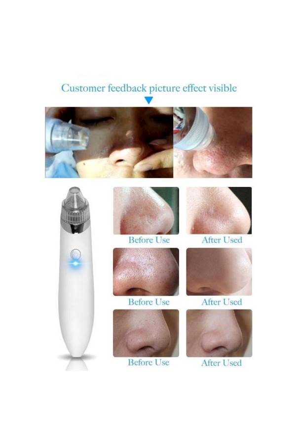 Dead Skin Remover Vacuum Suction White - Image 2
