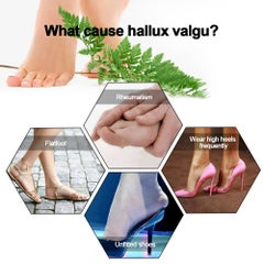 Generic Thumb Straightener Bunion Stretchers Protector  - Image 2