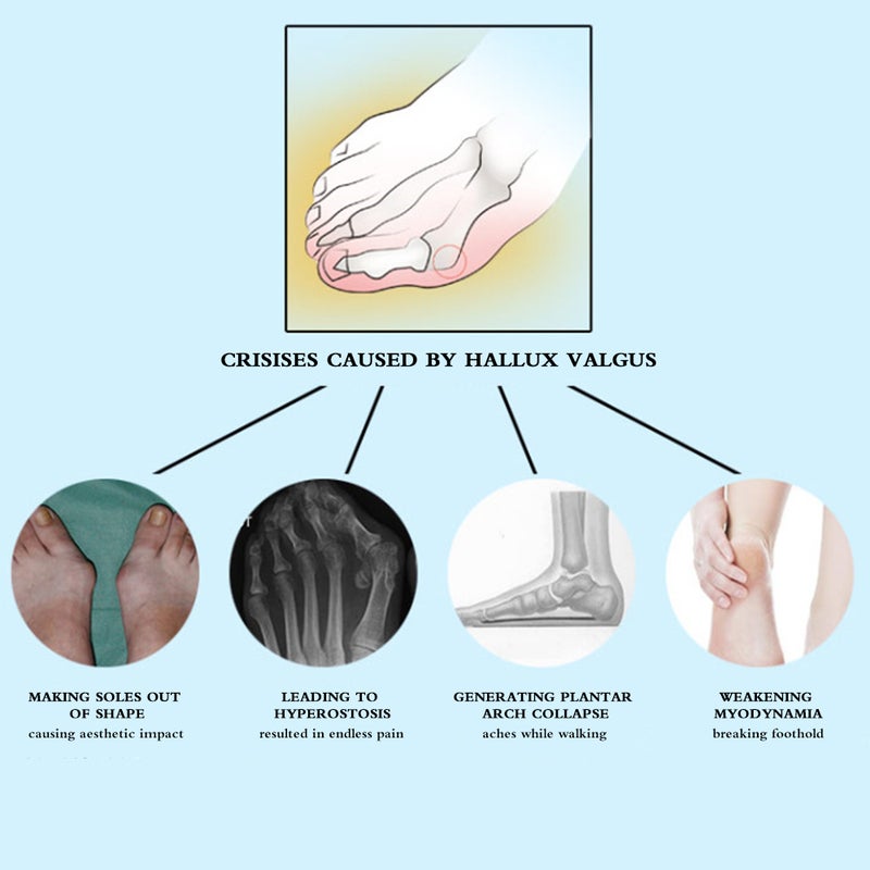 1-piece Adjustable Big Toe Corrector Straightener Foot Pain Relief Orthopedic Foot Care Tool - Image 5