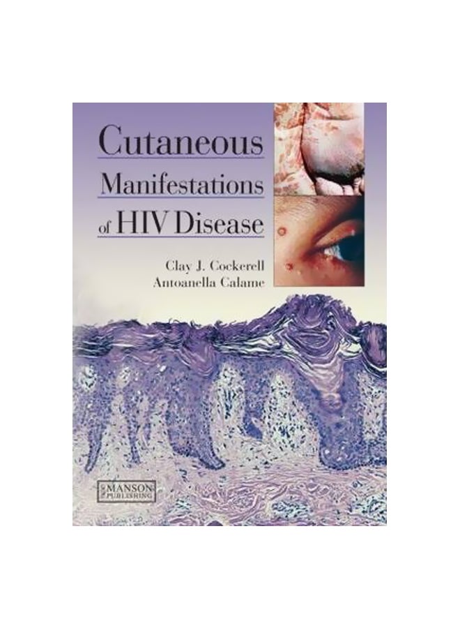 Cutaneous Manifestations Of HIV Disease Hardcover English by Clay J. Cockerell - 41196