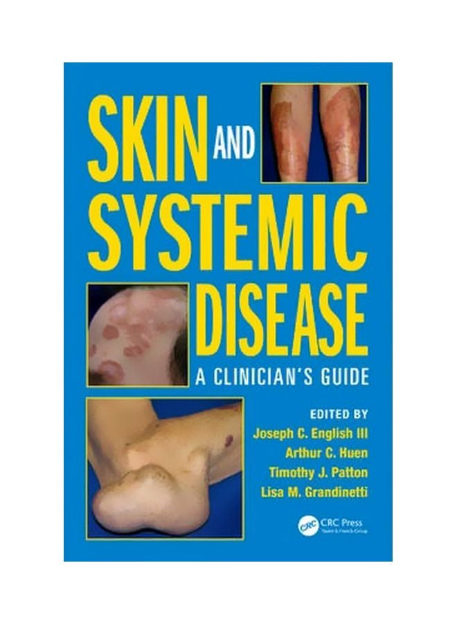 Skin And Systemic Disease: A Clinician's Guide Hardcover English by Joseph C. English III - 12 February 2015 