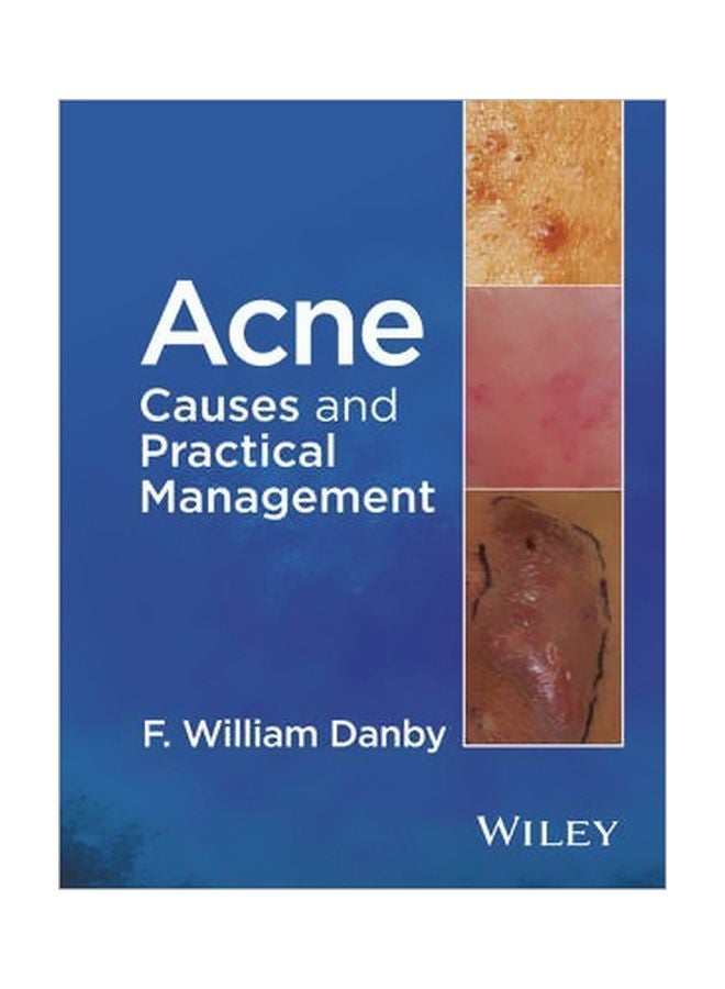 Acne: Causes And Practical Management Hardcover English by F. William Danby - 16 February 2015 