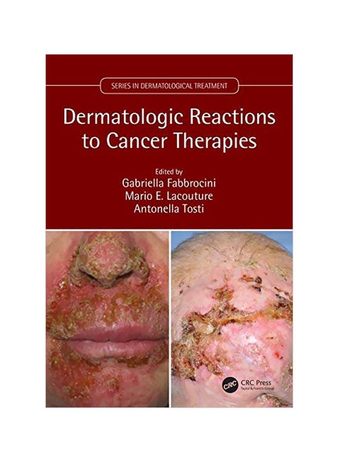 Dermatologic Reactions To Cancer Therapies Paperback English - 12-May-19