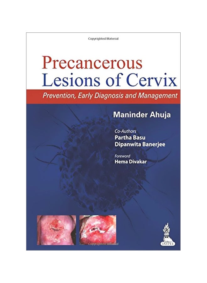 Precancerous Lesions Of Cervix : Prevention, Early Diagnosis And Management paperback english - 01 Jul 2014 