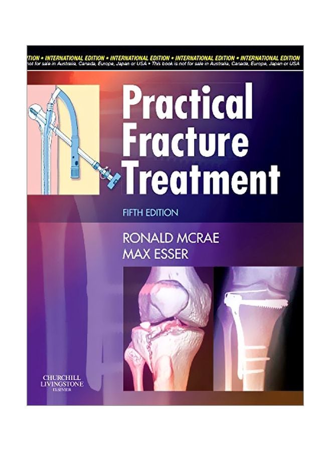 علاج الكسور العملي