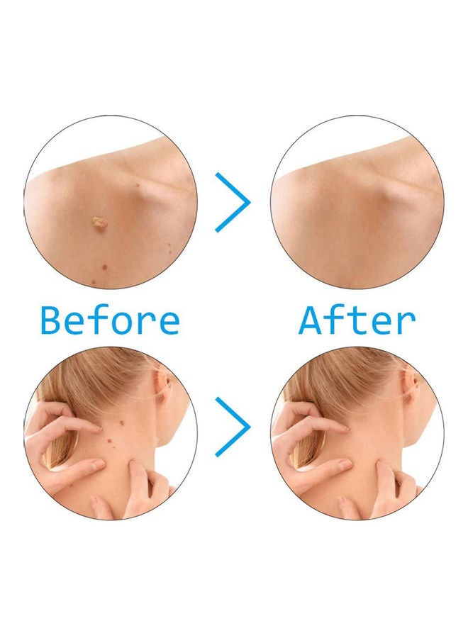 Generic - Skin Tag Removal Kit Skin Tag Remover Skin Mole Wart Remover Micro Band Skin Tag Removal Kit with Cleansing Pads Mole Face Care Green - Image 1