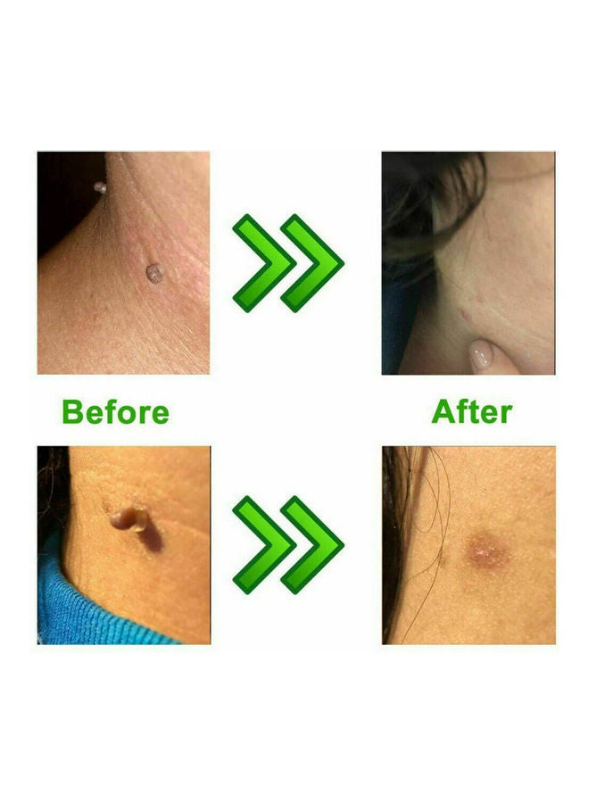 Generic - Skin Tag Removal Kit Skin Tag Remover Skin Mole Wart Remover Micro Band Skin Tag Removal Kit with Cleansing Pads Mole Face Care Green - Image 1
