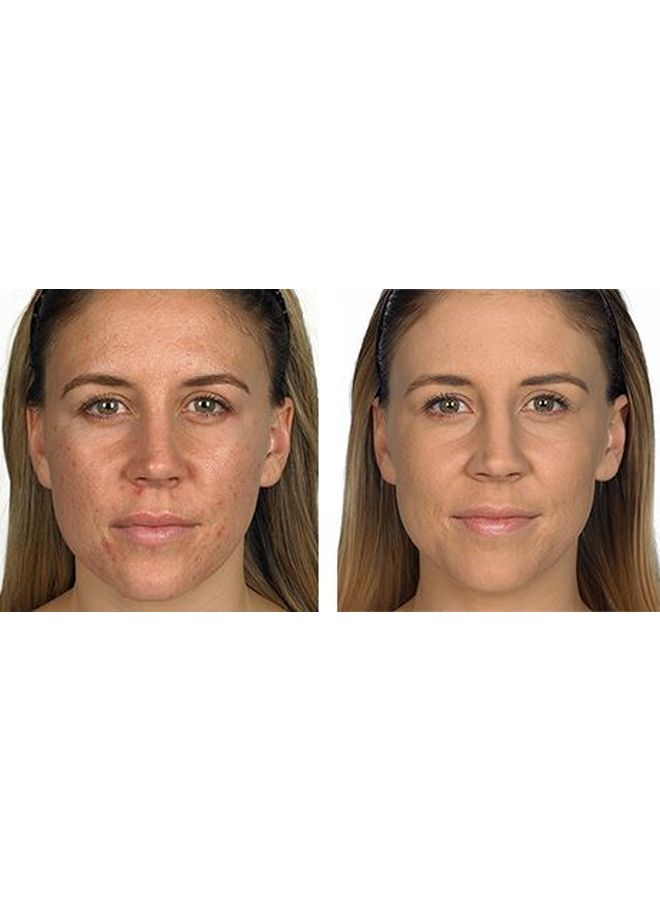 flormar Anti Blemish BB Cream SPF15 05 Medium - Image 3