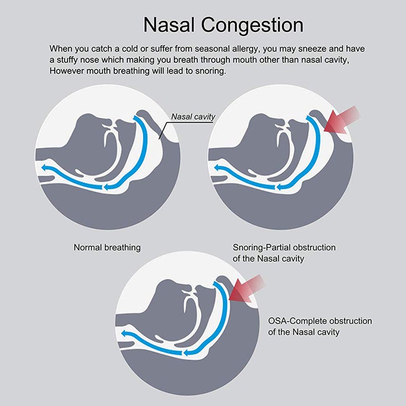 Woodyknows - Anti Snoring Nasal Dilators - Image 1