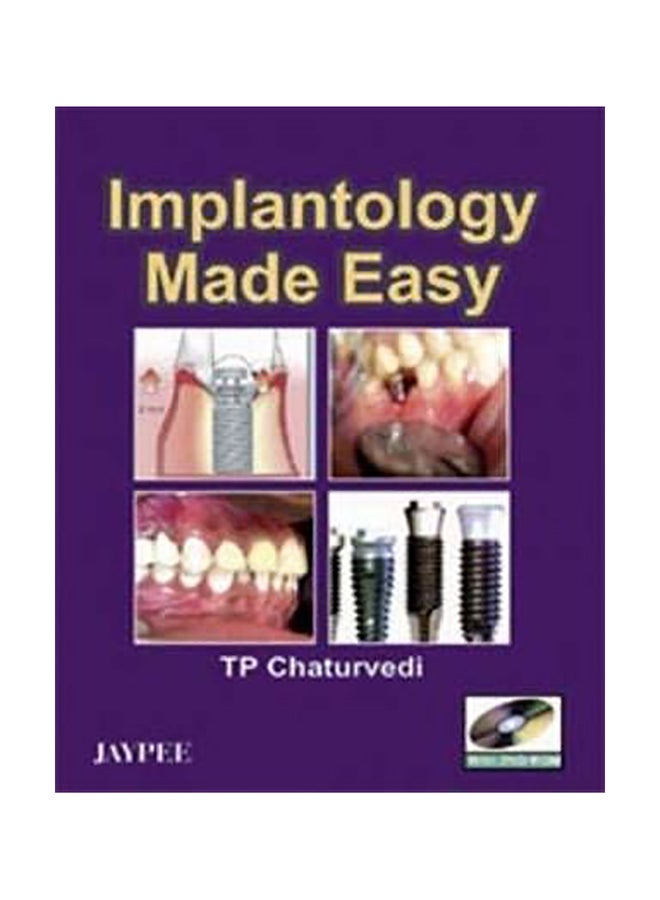 null - Implantology Made Easy Paperback English by TP Chaturvedi - Image 1
