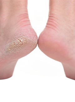 Generic Foot File For Corn And Callus Blue/Black  - Image 2