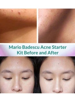 MARIO BADESCU Acne Repair Kit of 3 29ml, 29ml, 14g  - Image 3