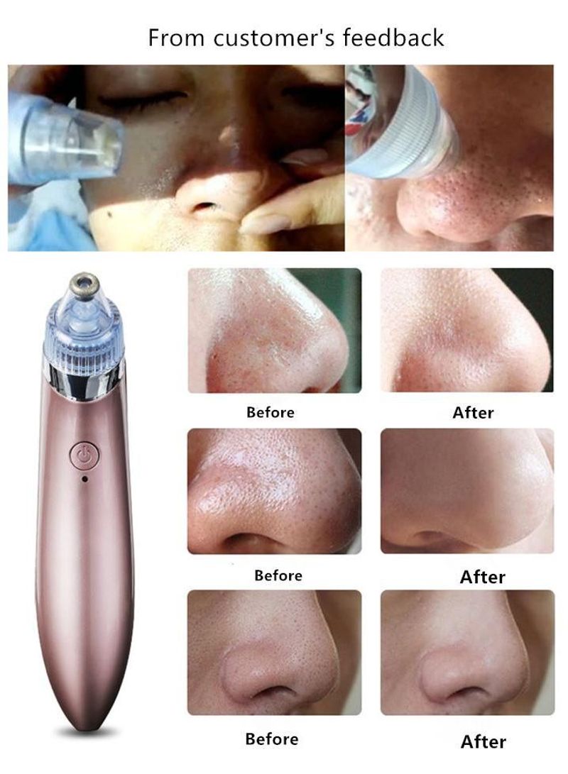 Generic Electric Blackhead Acne Pore Cleaner Rose Gold 22.2x6.4x15.2cm  - Image 1