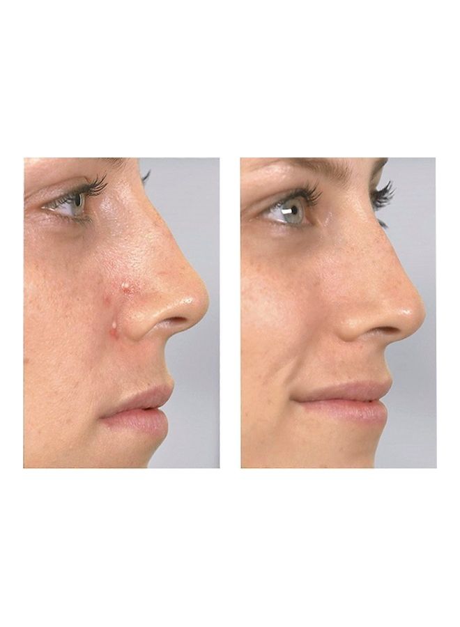 جهاز شفط لإزالة الرؤوس السوداء أزرق/ أبيض - Image 2