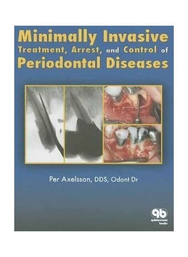 Minimally Invasive Treatment, Arrest, And Control Of Periodontal Disease Hardcover English by Per Axelsson